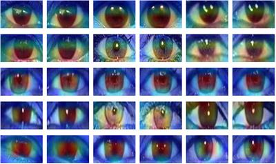 An Eyes-Based Siamese Neural Network for the Detection of GAN-Generated Face Images